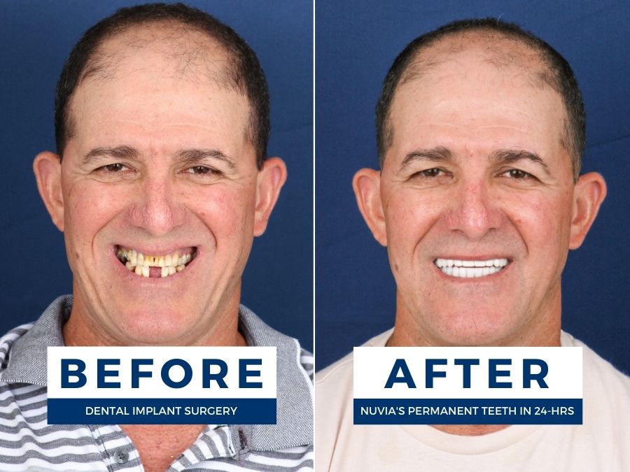 man smiling before and after teeth implants