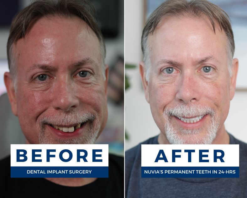 Chris before and after dental implants smiling