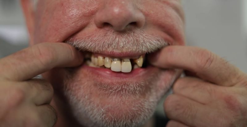 The Ultimate Guide to Full Mouth Dental Implants