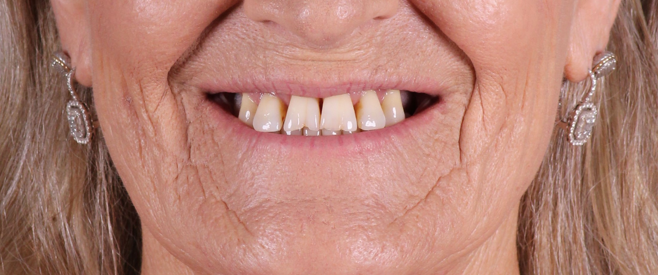 Thick gums causing pocketing around teeth