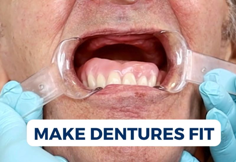 Dentures that are falling out because of thick gums