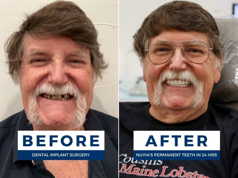 Patient who skipped temporary teeth before and after permanent teeth in 24 hours