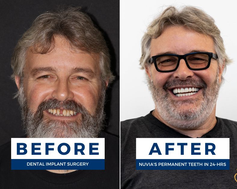 Man who had used a dental flipper before and after dental implants smiling