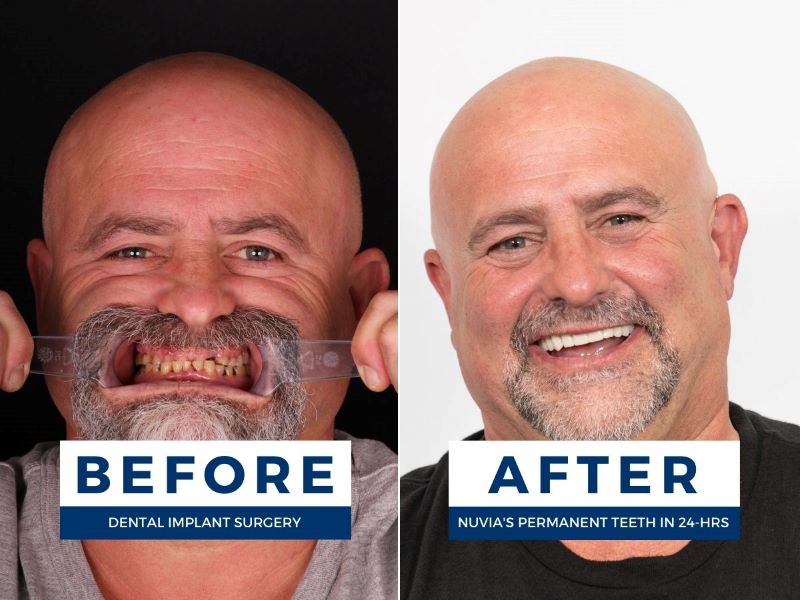 Man smiling before and after getting false teeth