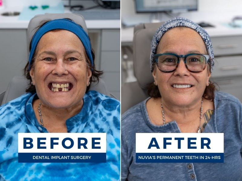 Woman smiling before and after her full mouth reconstruction