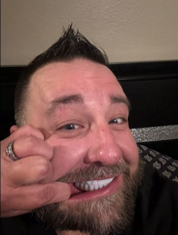 Shaun showing off his alterative to dentures by pulling his lips back