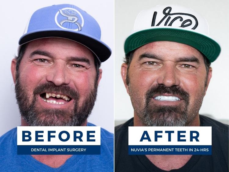 Before and after dental implants in portland or