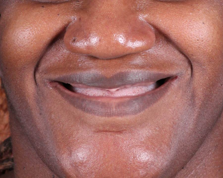 Erika's smile before getting dental implants