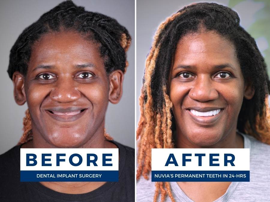 Erika smiling before and after getting dental implants