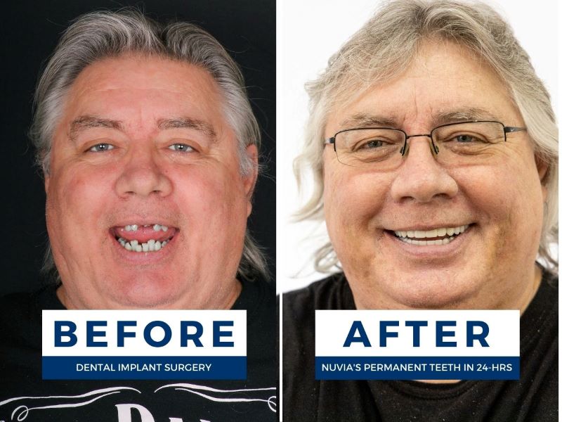 Darren before and after the benefits of dental implants