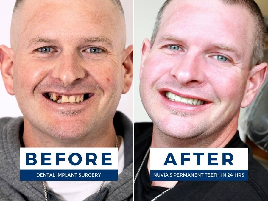 Before and after patient found someone who does dental implants
