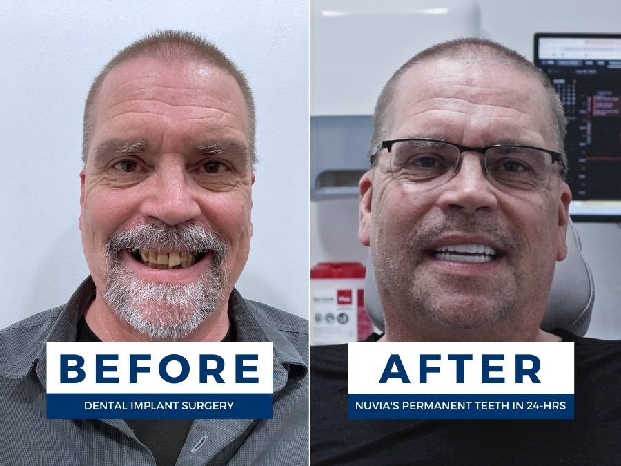 Before and after the cost of full mouth dental implants