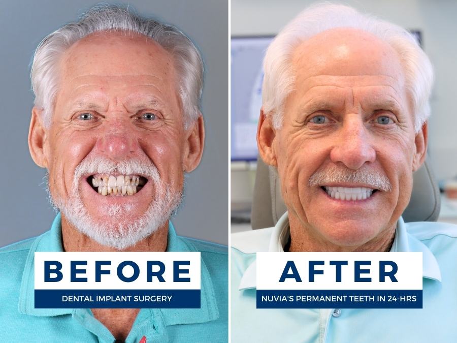man smiling before and after dental implants