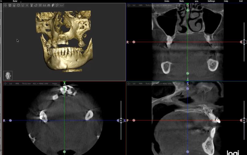 X Ray of patient Jaw