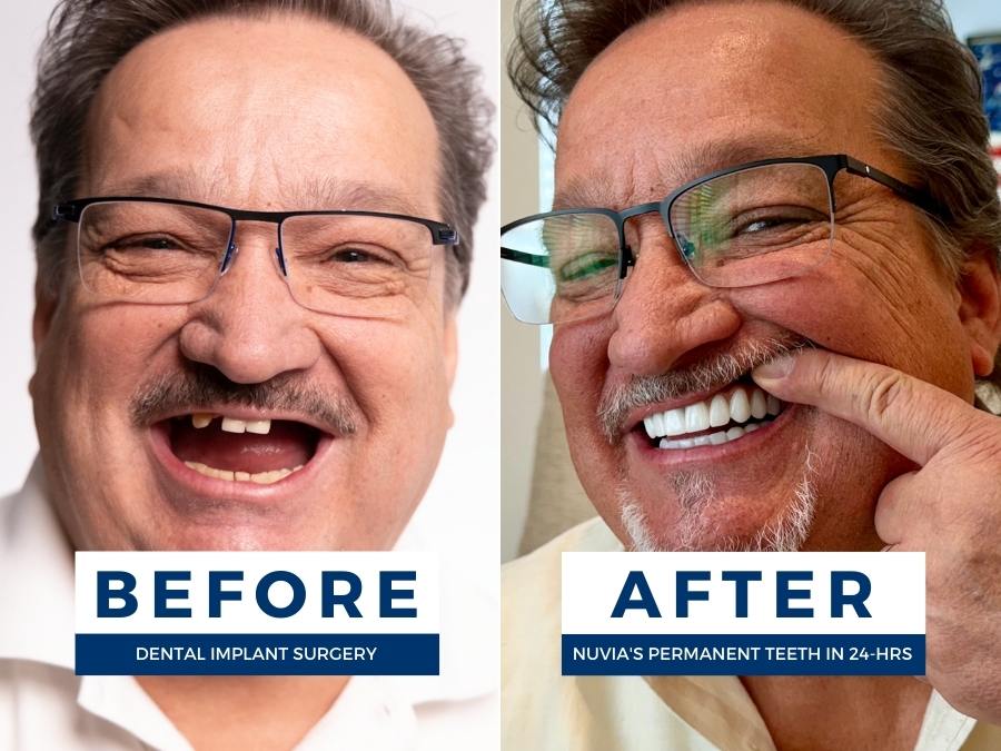 Man before and after dental implants smiling