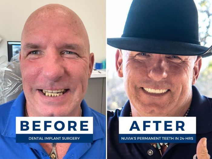Ricky smiling before and after getting permanent dental implants