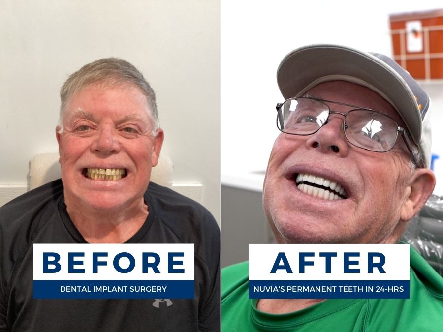Patient smiling before and after getting dental implants in lemont, il