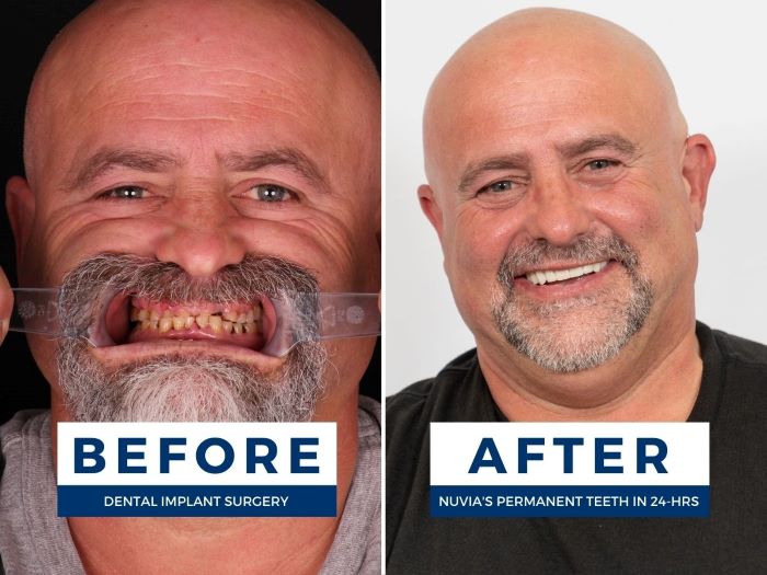 Chris smiling before and after a smile restoration
