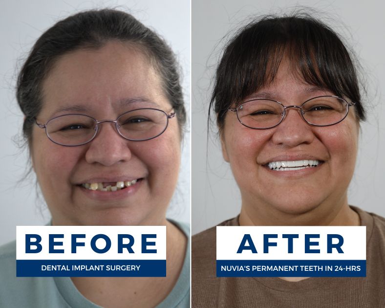 Christiana smiling before and after getting dental implants