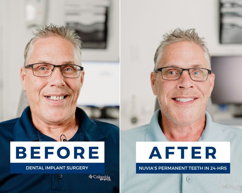 The Ultimate Guide to Full Mouth Dental Implants
