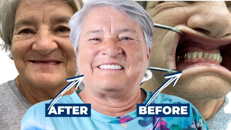 Before and after zygomatic implants