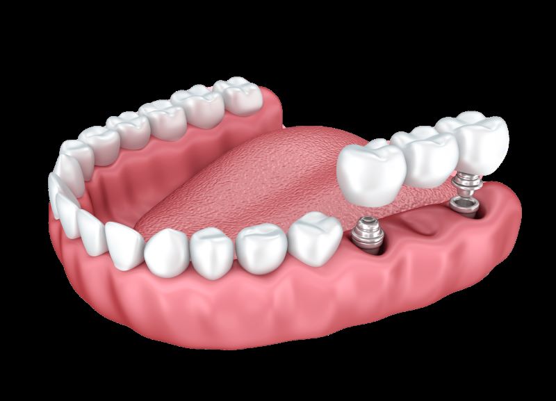 Dental Implants: Bridge Dental Implants Illustration