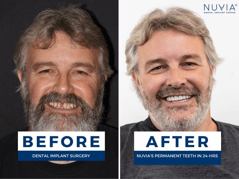 Dental implant patient smiling before and after treatment