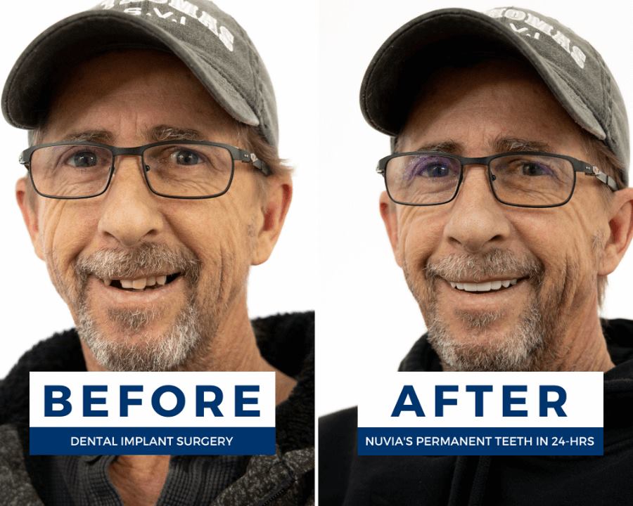 Dental implant patient before and after dental implants
