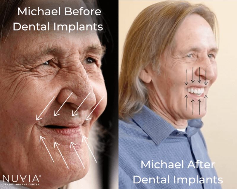 Michael smiling before and after dental implants