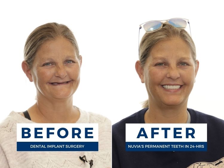 Woman with palateless denture before getting dental implants