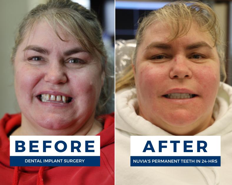 Jessica smiling before and after getting full mouth dental implants in dallas, tx
