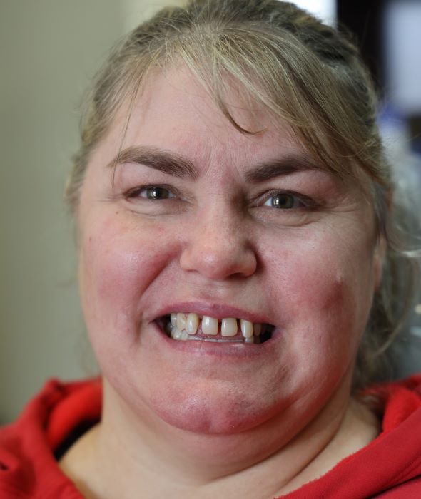 Jessica smiling before getting full mouth dental implants in dallas