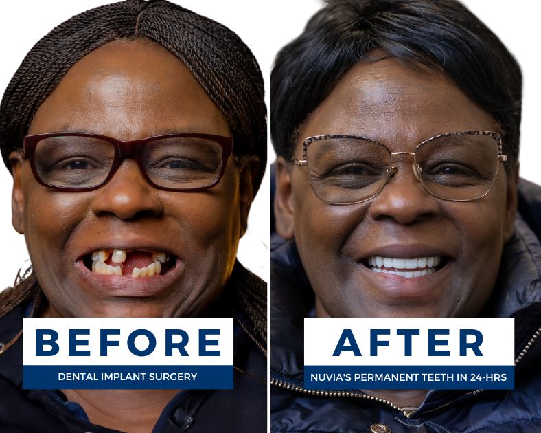 Happy woman before and after getting dental implants in san deigo