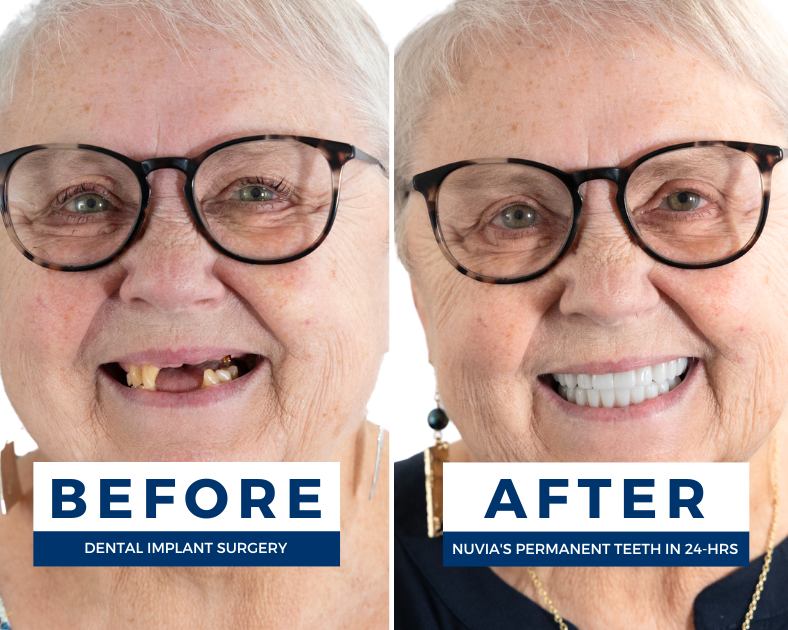 Woman smiling before and after dental implants in san diego