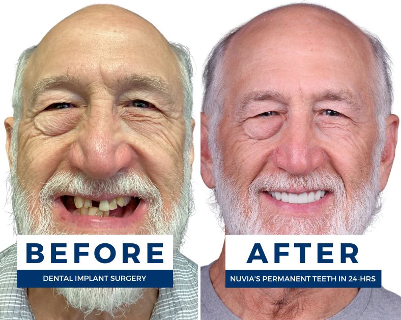 man smiling before and after dental implants in san diego