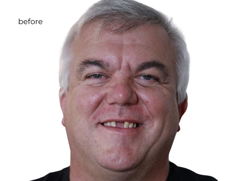Man smiling before getting dental implants