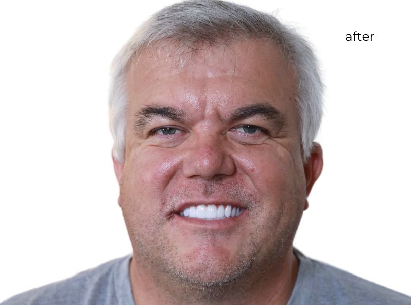 Man smiling after getting dental implants
