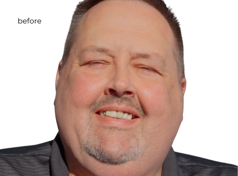 Man smiling before dental implants