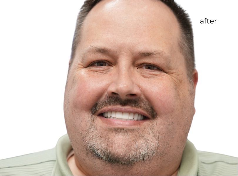 man smiling after getting dental implants