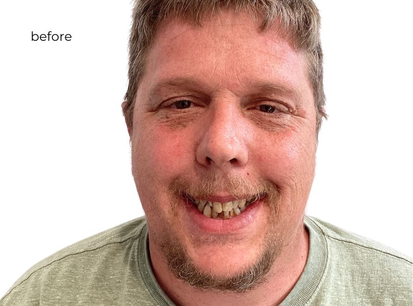 woman smiling before dental implants