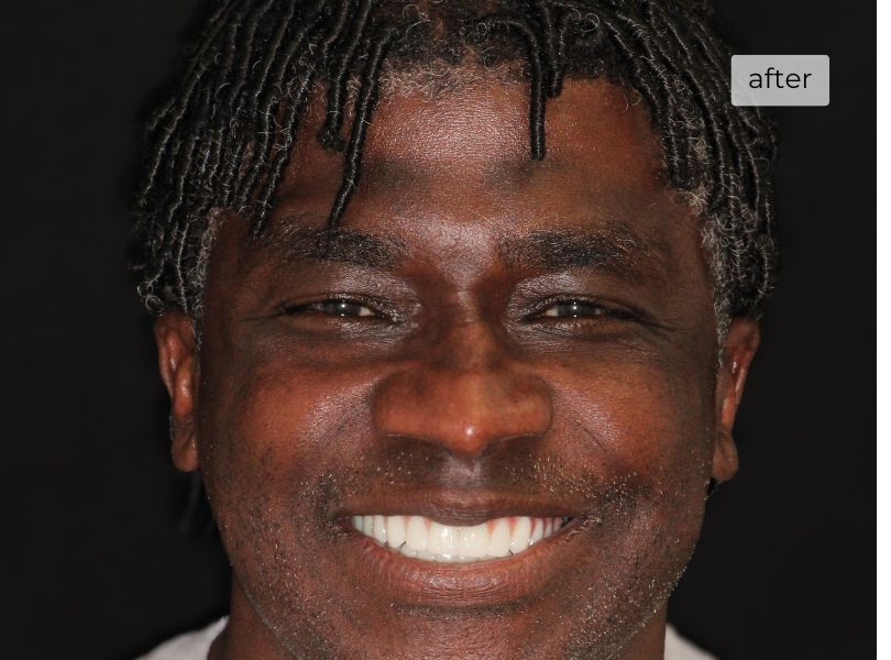 Man smiling after getting dental implants