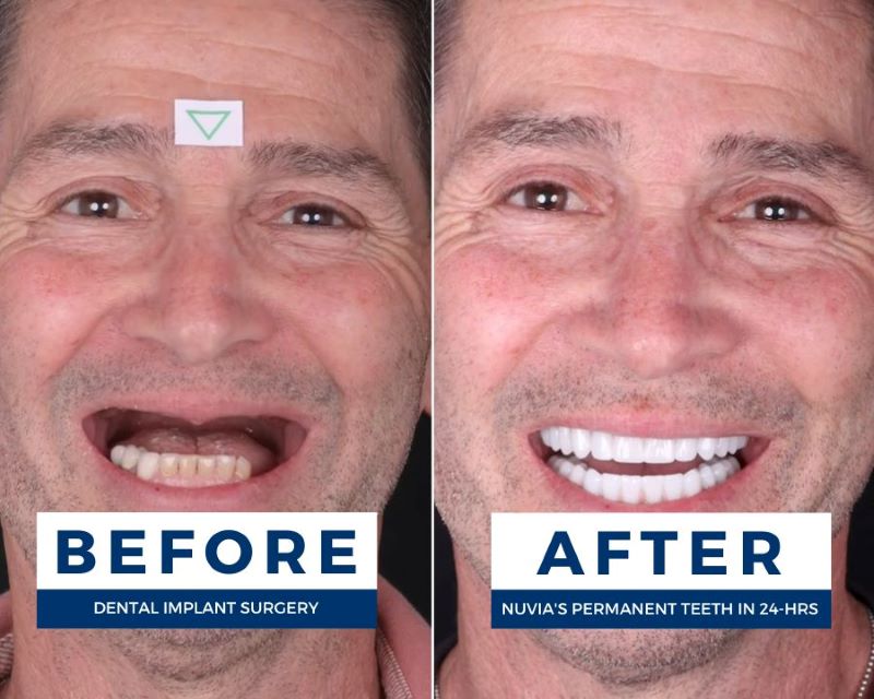 Christopher smiling before and after consequences of missing teeth