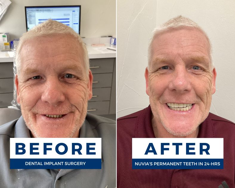 Wayne smiling before and after his dental implant procedure in Fort Worth, TX