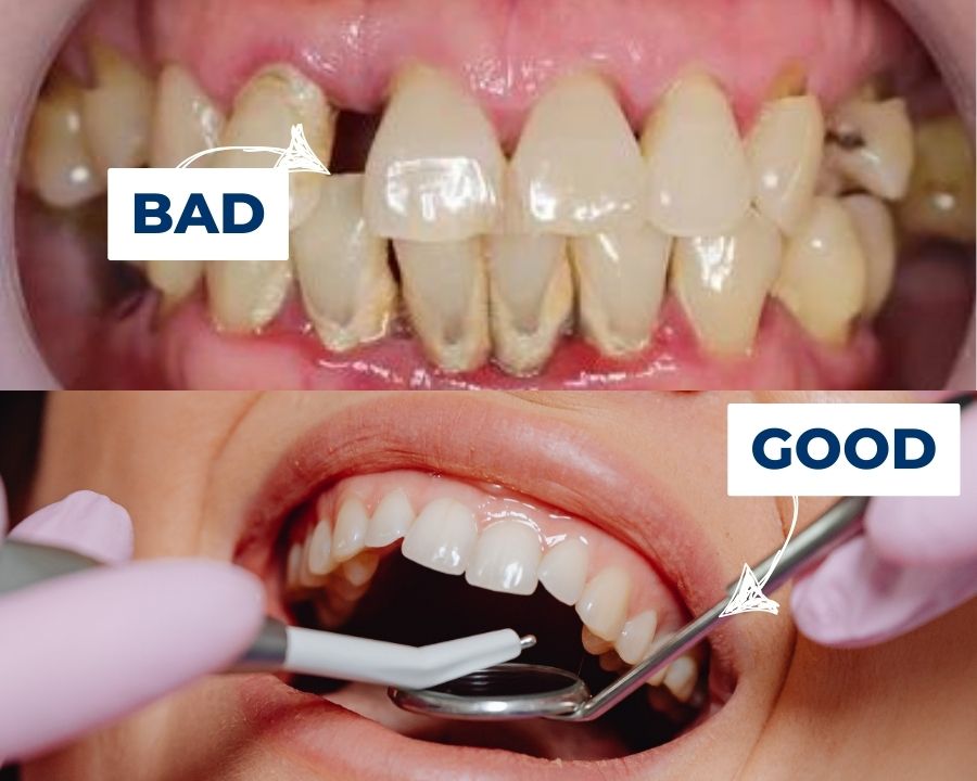 Early warning signs of poor gum health.