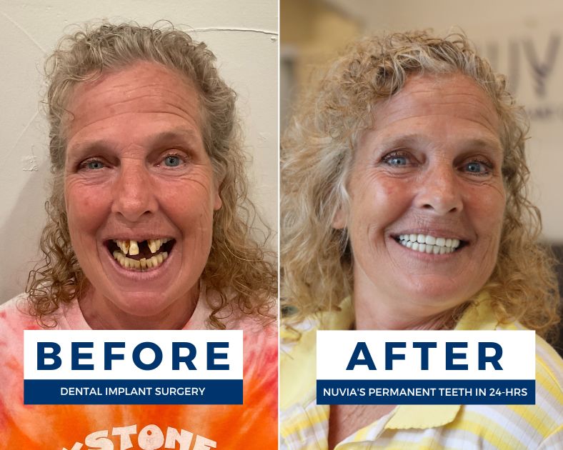 Christy smiling before and after getting permanent full dental implants