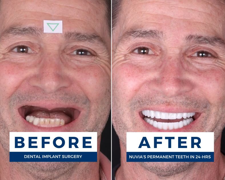 Man smiling before and after getting new teeth and wondering do dentures cause bone loss