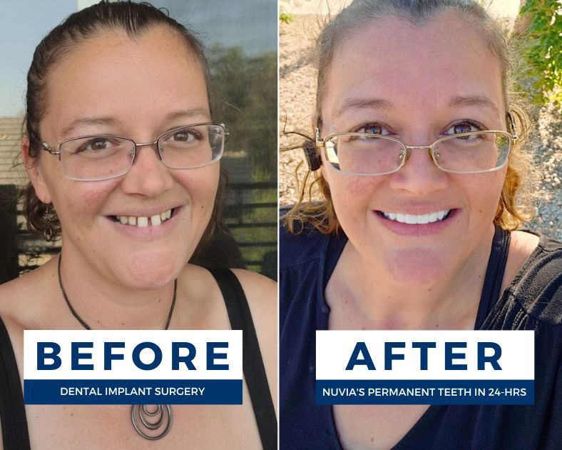 V Smiling before and after experiencing the advantages of dental implants