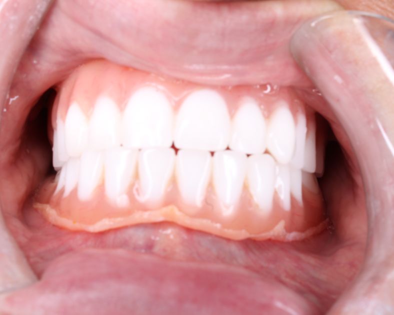 Close up of problematic dentures