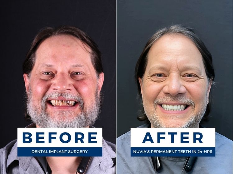 Man smiling before and after getting same day dental implants