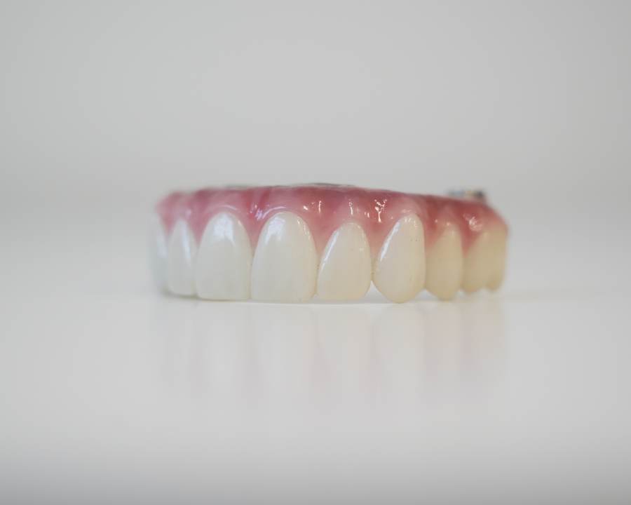 Set of zirconia teeth before being attached to same day dental implants